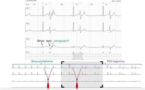 PVC | ECG Guru - Instructor Resources