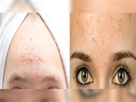 Home remedies small bumps on forehead ssh | गर्मी आने से पहले माथे पर ...