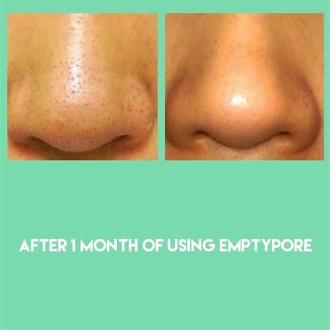 Image result for Sebum Plug Extraction