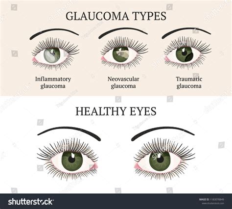 Eye Disease Ophthalmology Health Glaucoma Types Stock Vector (Royalty Free) 1183078849 ...