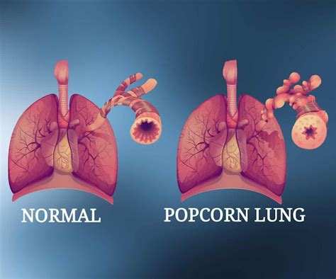 Emphysema Life Expectancy 的图像结果