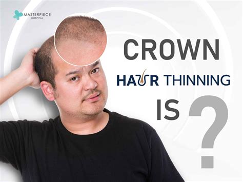 Thinning Hair on Crown? Check Early Before Complete Hair Loss