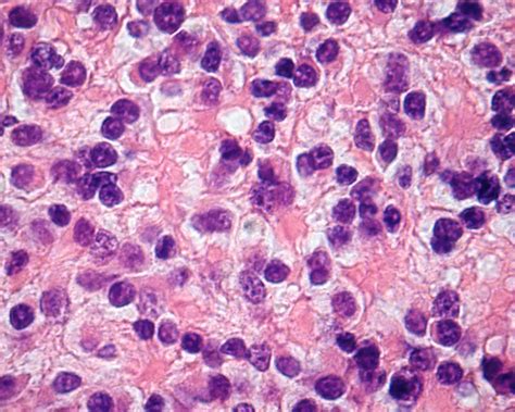 Review of Retinoblastoma - American Academy of Ophthalmology