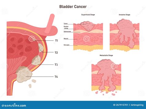 Stages of Bladder Cancer. Human Internal Organ Wall with a Developing ...