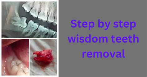 Image result for Wisdom Teeth Removal Procedure