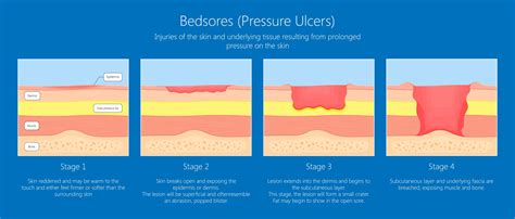 What are the Different Stages of Bedsores? | MedMalFirm.com