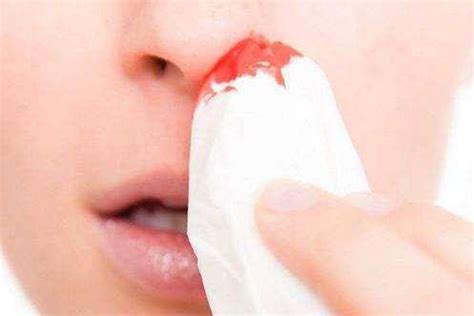 为什么鼻子总爱出血?鼻部或全身疾病所致(鼻腔血管破裂) - 探秘志