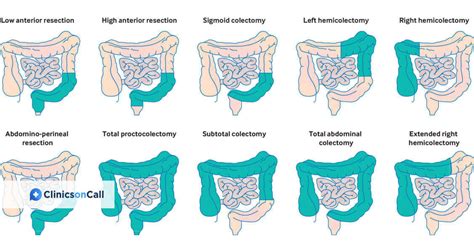 Image result for Colon Cancer Surgery Procedure