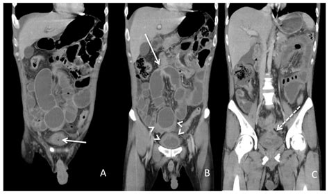 Management of Enterovesical Fistula in a Patient with Crohn’s Disease ...