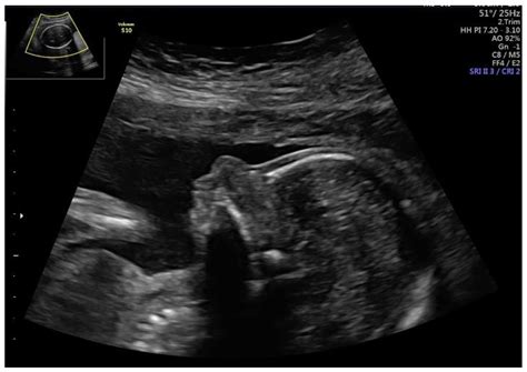 Down Syndrome Symptoms In Ultrasound