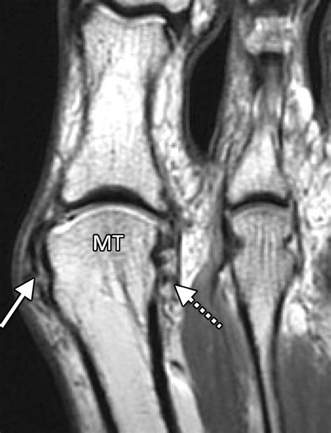 Injury To Mtp Joint at Douglas Wilder blog