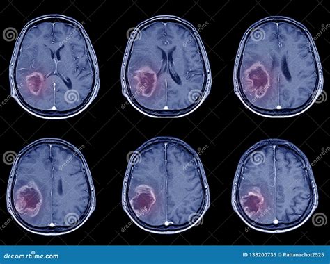 CT-Scan Brain Imaging for Hemorrhagic Stroke or Ischemic Stroke Stock ...