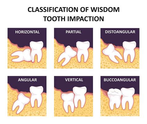 What To Do When Wisdom Teeth Hurt?