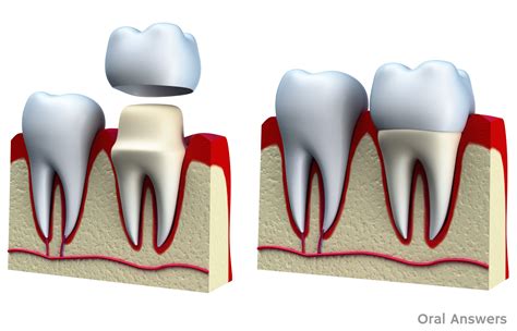 Crown For Your Tooth at Gail Summers blog
