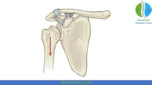 Image result for Negative Sulcus Sign