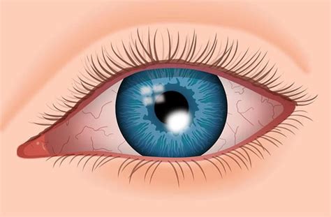 What Is a Corneal Descemetocele?