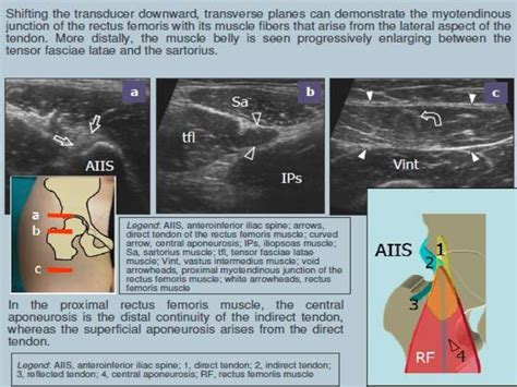 How to Perform Hip Ultrasound 的图像结果