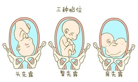 孕婦胎位不正，醫生隔肚皮徒手扭轉嬰兒，一分鐘剖腹產變順產 - 每日頭條