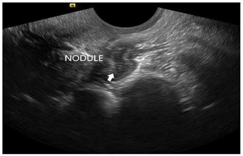 Transvaginal Ultrasound in the Diagnosis and Assessment of Endometriosis—An Overview: How, Why ...