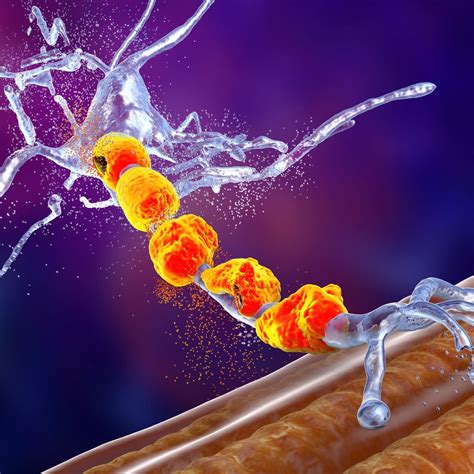 Amyotrophe Lateralsklerose – was ist neu? - Neurologie - Universimed ...