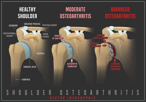 Shoulder Arthritis - Motion Health Centre