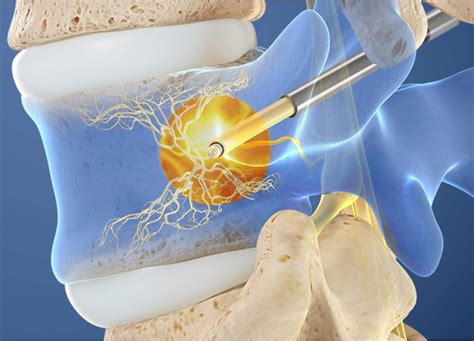 Basivertebral Nerve Radiofrequency Ablation (Intracept) | Physicians ...