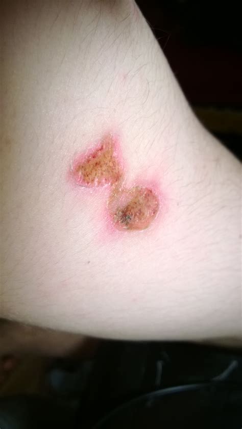 Burning Blister Wound Scab Slough Crust Eschar Scurf | Flickr - Photo ...