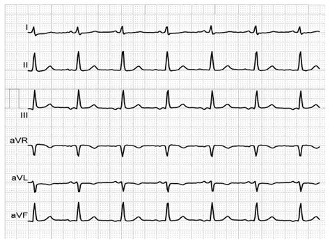 Bayés’ Syndrome—A Comprehensive Short Review