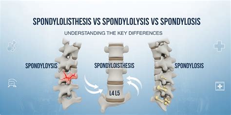 Spondylolisthesis, Spondylolysis, and Spondylosis: Key Differences