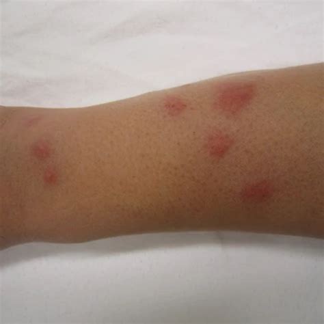 Asian Lady Beetle Bite Symptoms