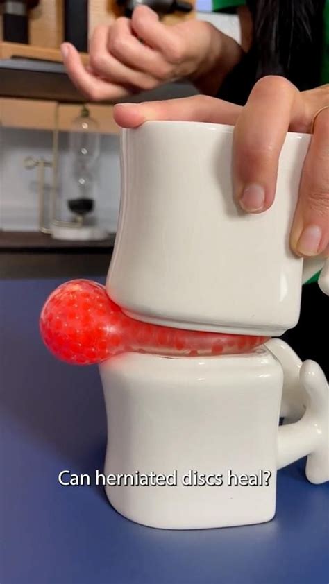 Image result for Exercise for Bulging Disk