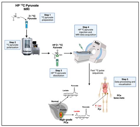 Lactate as Key Metabolite in Prostate Cancer Progression: What Are the ...