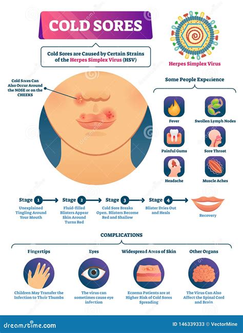 Cold Sores Vector Illustration. Medical Labeled Herpes Simplex Virus Scheme Stock Vector ...