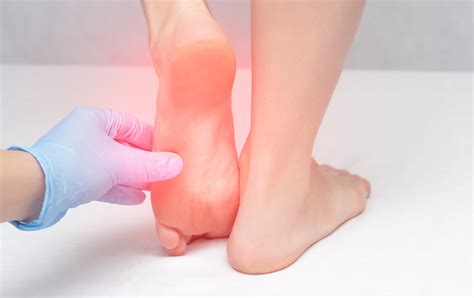 Can Uric Acid Cause Heel Pain? Signs of Gout in the Heel | Heel That Pain