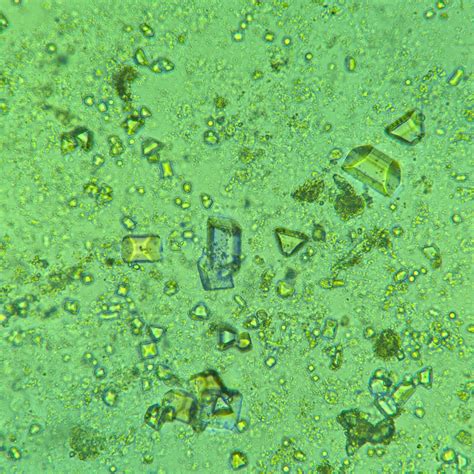 Triple Phosphate Crystals: Identification & Clinical Significance