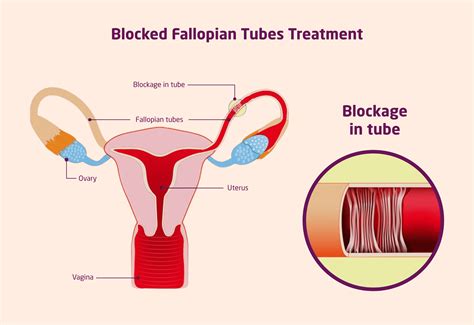 Image result for Removing Fallopian Tubes