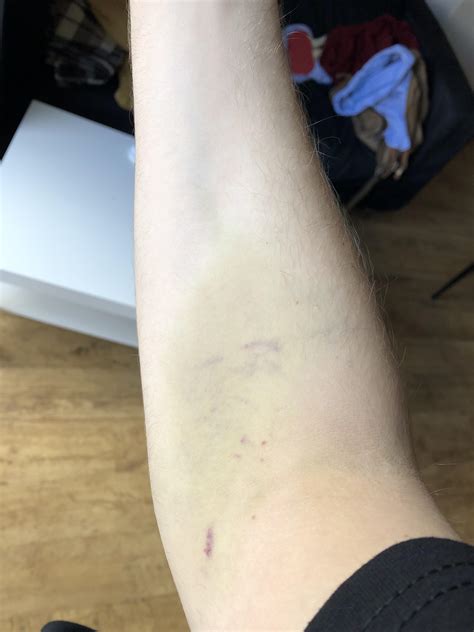 Blood Donation Bruises