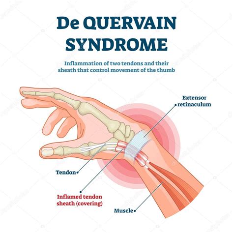 Ilustración vectorial del síndrome de Quervain. Esquema de inflamación ...