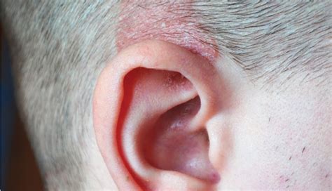 How To Treat Scabs On The Scalp - lifeberrys.com