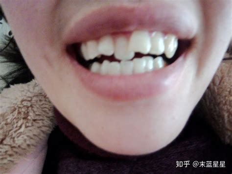 我想知道我这个牙齿如果整牙要拔牙吗，还有整完牙之后会松动吗 - 知乎