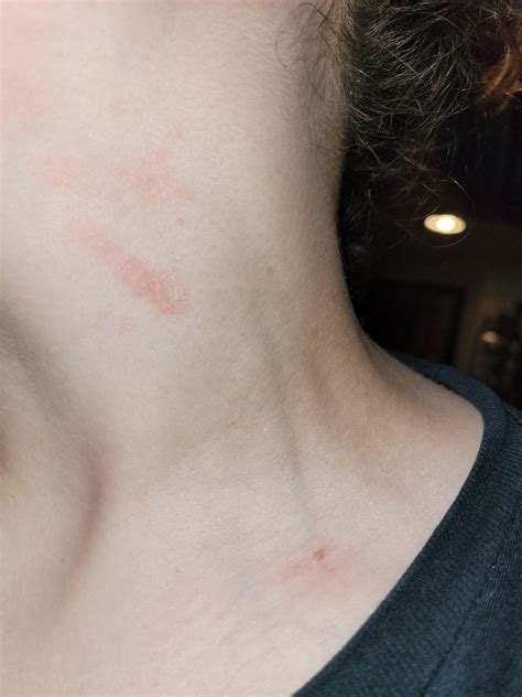 Rash on Neck that showed up 3 days ago, wasn't itchy before, but now is tonight. More info in ...