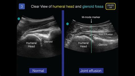 Hip: Normal And Pathology - Internet Book Of MSK Ultrasound