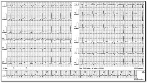 Atrial Rhythm