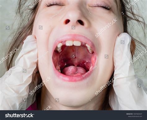 Herpes In Throat Images