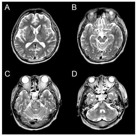 Osmotic Demyelinataion Syndrome in a Patient With Hyper-Ammonemia and ...