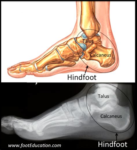 Hindfoot Fractures | OrthoPaedia