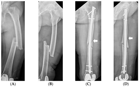 Risk Factors Associated with Intraoperative Iatrogenic Fracture in ...