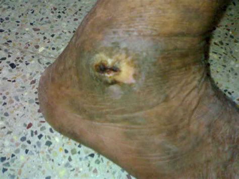 ASHTAVINAYAK HOMOEOPATHIC HEALING CENTRE, PUNE | Case Details | Leprosy ...