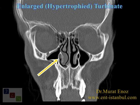 Swollen Turbinates: A Visual Guide with Pictures, Causes, and Treatments