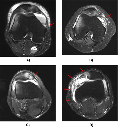 Medial patellofemoral ligament injury. Location-based rate of recurrent ...